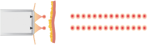 [HIFU] 10Thera (TENTHERA) - HIFU Lifting & Tightening