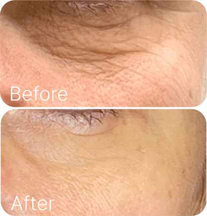 [Microneedle & Radio Frequency] ELLISYS SENSE