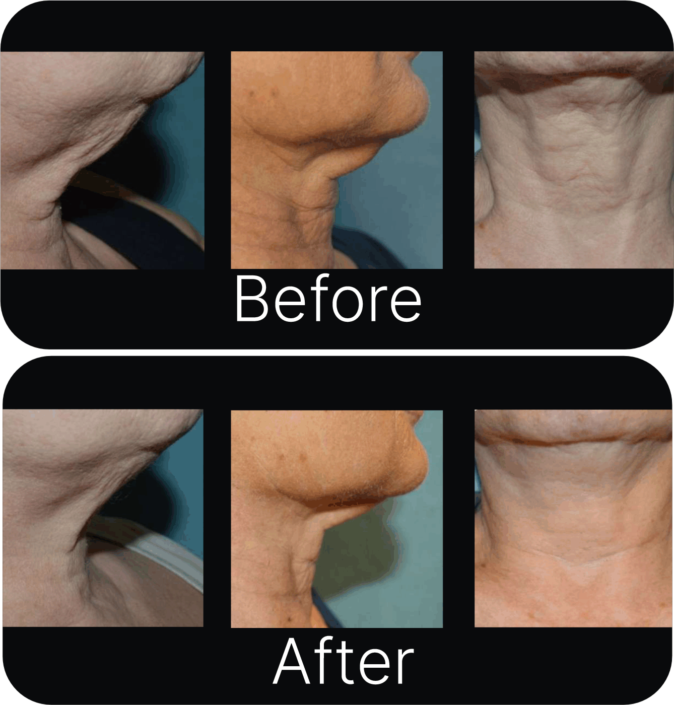 [Microneedle & Radio Frequency] ELLISYS SENSE