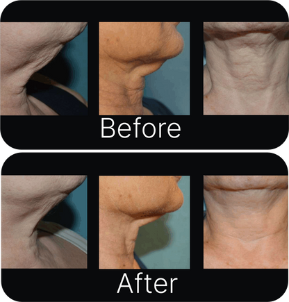 [Microneedle & Radio Frequency] ELLISYS SENSE